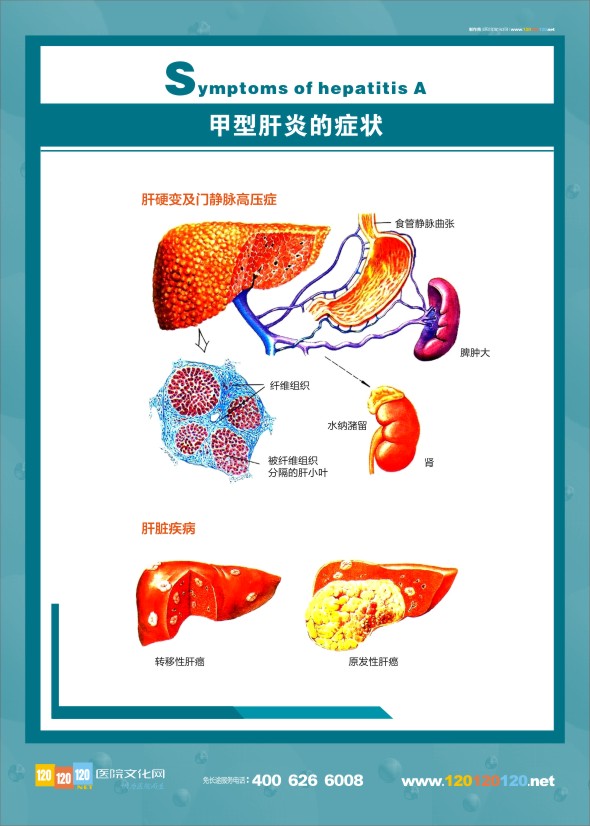 肝臟解剖圖 肝病科解剖圖-甲型肝炎的癥狀